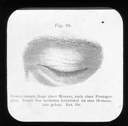 Anatomi; Øyet. Øyespalten, lukket.